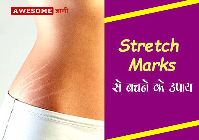 How to remove stretch marks in hindi
