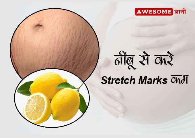 Reduce stretch marks with lemon